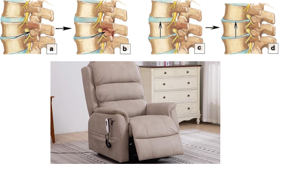 Recliners for Degenerative Disc Disease