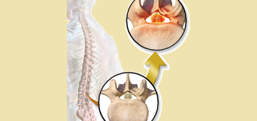 Recliner for Spinal Stenosis