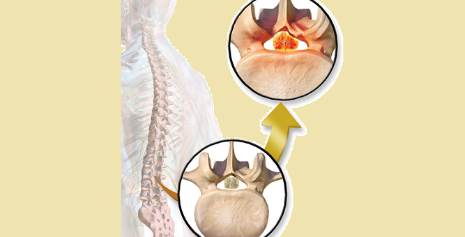 Recliner for Spinal Stenosis